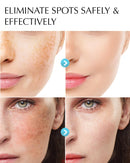 Dark Spot Remover for Face and Body: Hyperpigmentation Treatment - Natural Ingredient - Freckle/Melasma/Sun Spot/Age Spot Remover - Dark Spot Corrector Cream for Women and Men