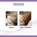 Thickening Hair Loss Treatment for Women
