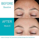 Retinol Serum for Post-Acne Marks and Skin Texture